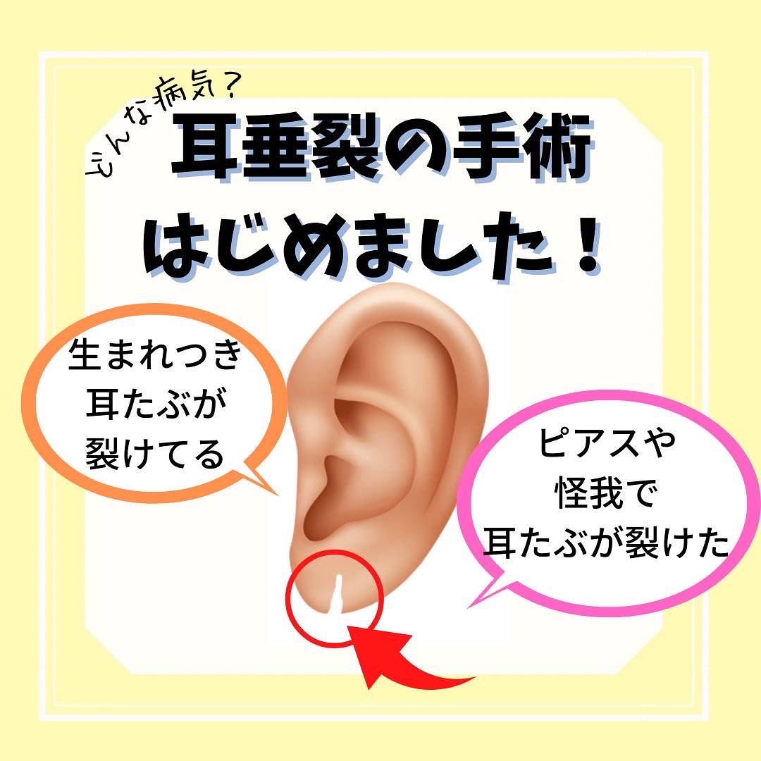 不能戴耳环的痛，耳垂畸形是什么？_耳部整形_耳部整形治疗介绍 - 好大夫在线